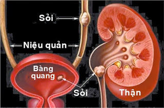 một số nguyên nhân gây sỏi thận