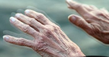 Bệnh parkinson gây mất kiểm soát điều tiết mồ hôi