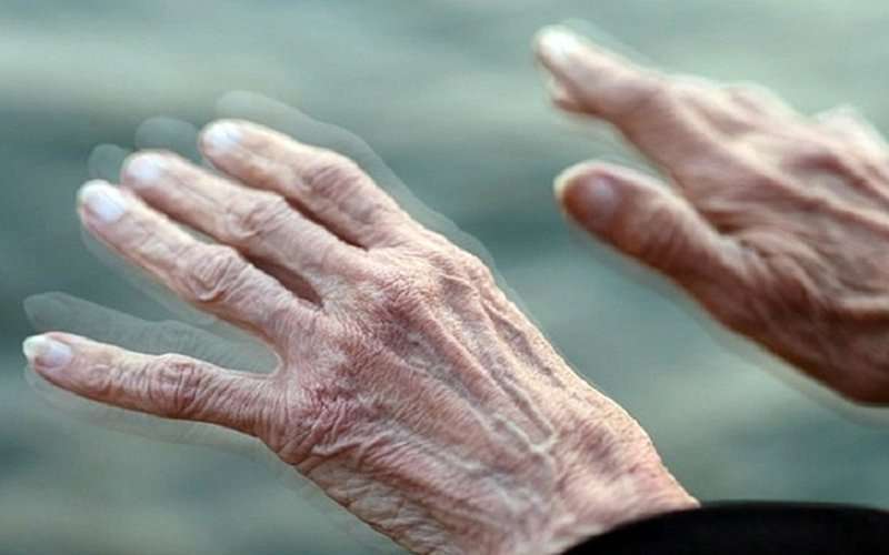 Bệnh parkinson gây mất kiểm soát điều tiết mồ hôi
