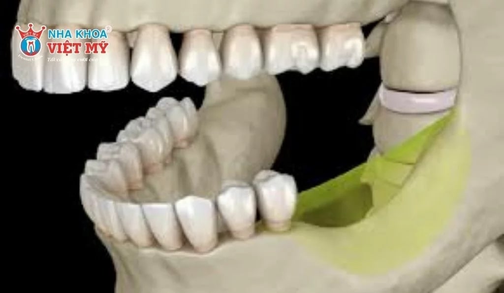 Trồng răng implant ngăn chặn tình trạng tiêu xương hàm