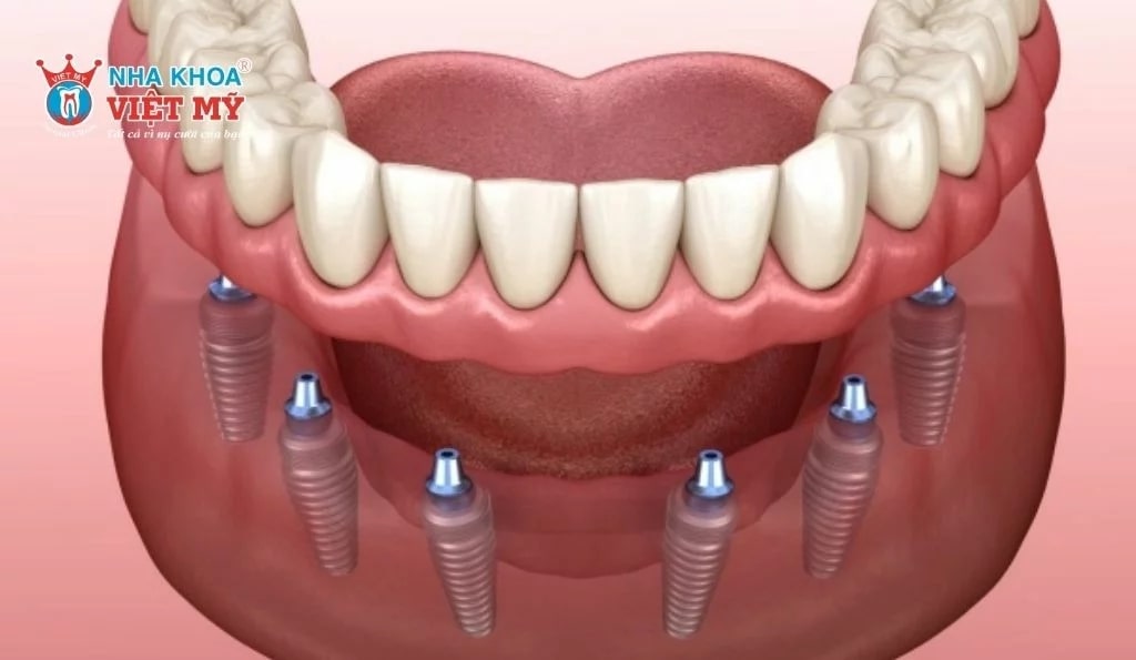 Trồng răng implant