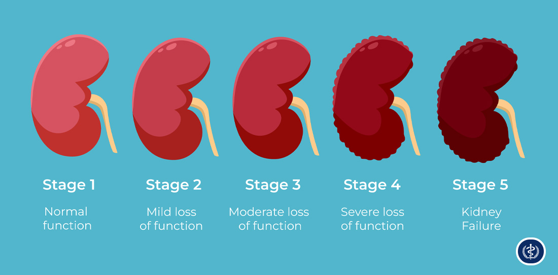 Bảng phân loại 5 giai đoạn suy thận dựa trên chỉ số GFR (độ lọc cầu thận).