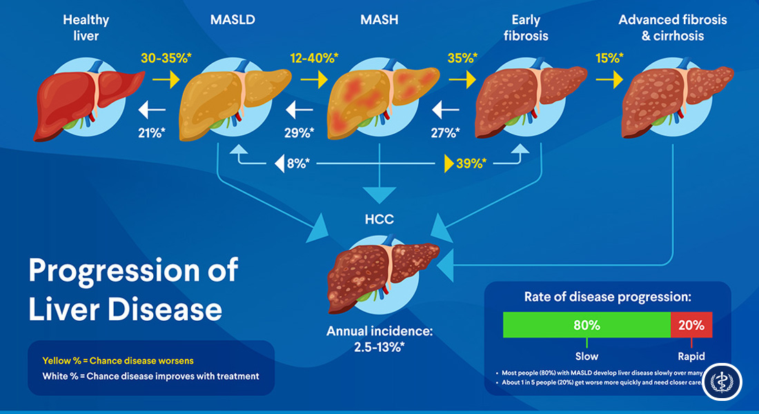 Tiếp Cận Chẩn Đoán Và Quản Lý Đa Mô Thức Bệnh Gan Nhiễm Mỡ Liên Quan Đến Rối Loạn Chuyển Hóa (MASLD) 2 Tiep Can Chan Doan Va Quan Ly Da Mo Thuc Benh Gan Nhiem Mo Lien Quan Den Roi Loan Chuyen Hoa MASLD