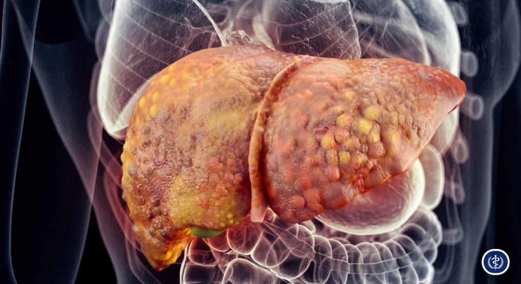 Tiếp Cận Chẩn Đoán Và Quản Lý Đa Mô Thức Bệnh Gan Nhiễm Mỡ Liên Quan Đến Rối Loạn Chuyển Hóa (MASLD) 1 Tiep Can Chan Doan Va Quan Ly Da Mo Thuc Benh Gan Nhiem Mo Lien Quan Den Roi Loan Chuyen Hoa MASLD 2