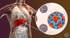 Viem Gan Sieu Vi B Cam Nang Toan Dien